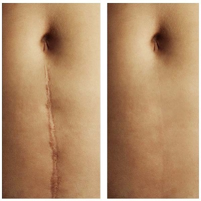 <span style="font-weight: bold;">Пластика рубцов<br></span>